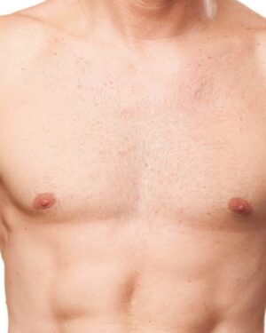 Escote Hombres - Depilación Láser