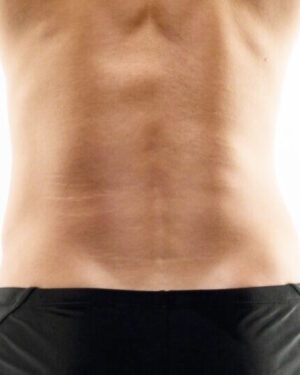 Triangulo Sacrocoxial Hombres - Depilación Láser