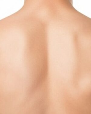 Hombros Hombres - Depilación Láser